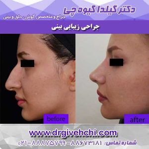 جراحی بینی