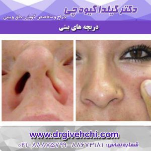 دریچه های بینی